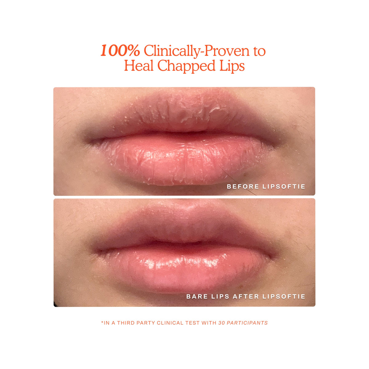 LipSoftie · Tratamiento labial